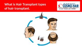 What is hair transplant and types of hair transplant.pptx
